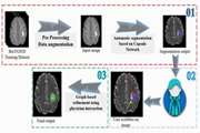 طراحی و پیاده سازی الگوریتم تعاملی به منظور بخش ­بندی گلیومای مغزی در تصاویر MRI با استفاده از روش ­های یادگیری عمیق