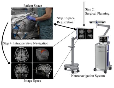 ارایه روش انطباق ترکیبی داده های فوتواکوستیک و MRI در فضای تنک به منظور محاسبه تغییر فرم بافت مغز در حین جراحی به کمک سیستم IGS